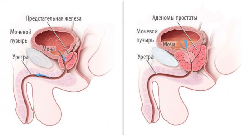Симптомы аденомы простаты (предстательной железы): признаки, диагностика у мужчин