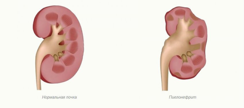 Дисфункция мочевого пузыря, гипотония и гиперрефлекторная патология у детей