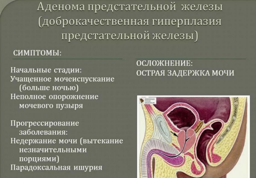 Мочевой пузырь не опорожняется полностью у женщин и мужчин: причины, лечение