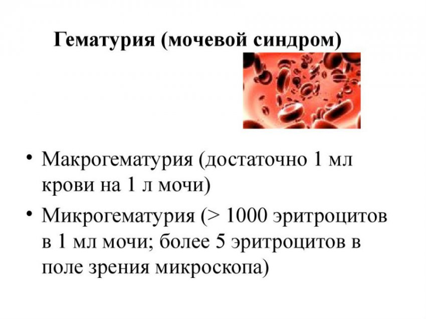 Симптомы гломерулонефрита у взрослых: диагностика, признаки заболевания почек