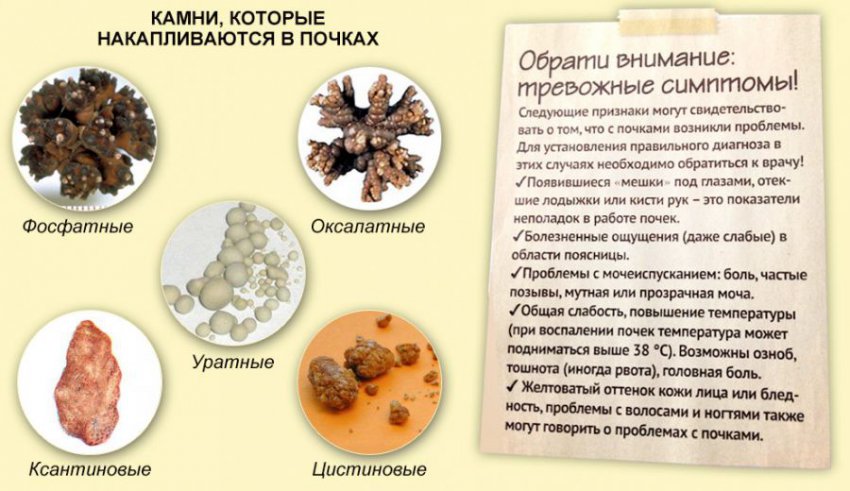 Фосфатные камни в почках и их растворение: фото и лечение заболевания