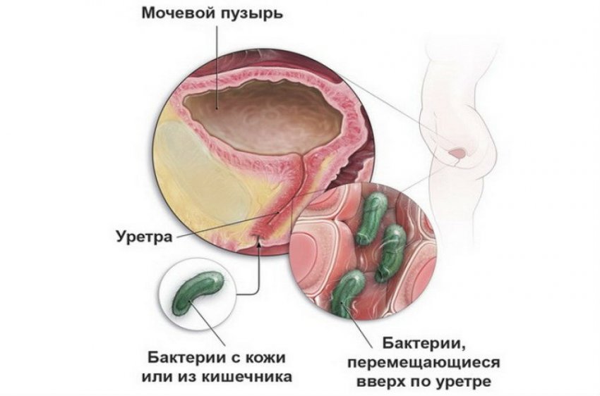 Жжение в мочеиспускательном канале (уретре) у женщин и мужчин: причины, лечение
