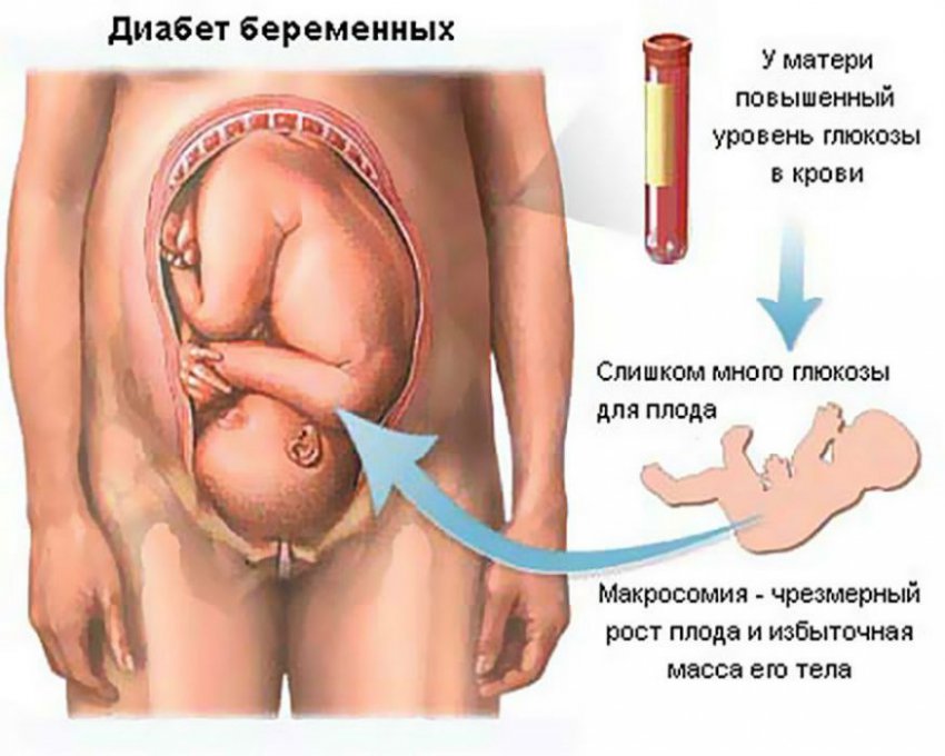 Ацетон в моче при беременности, причины содержания в анализе у беременных